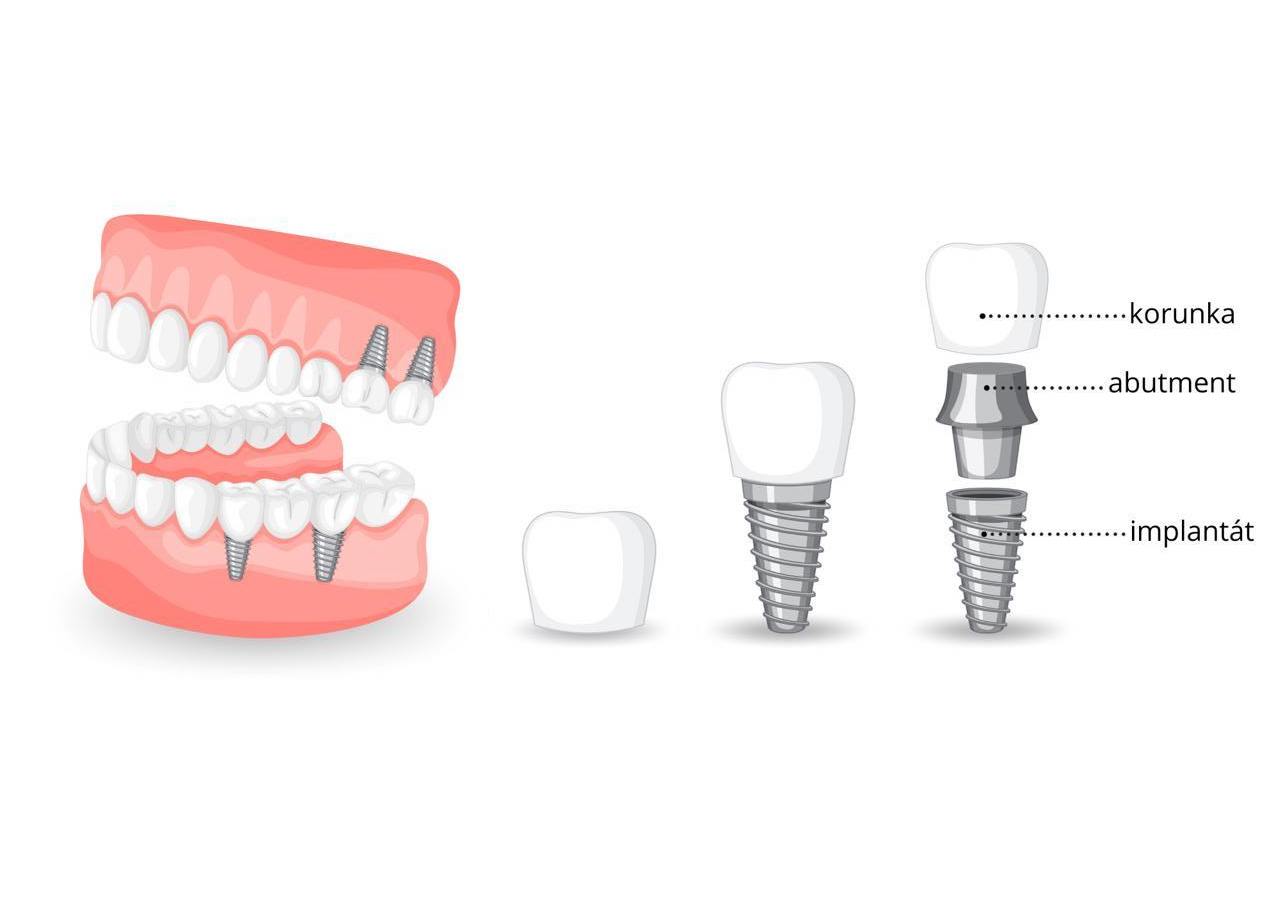 RoBeDent - zubní implantáty 1